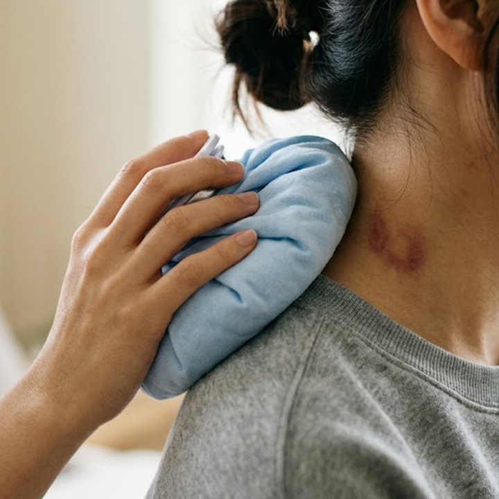 cara hilangkan love bite